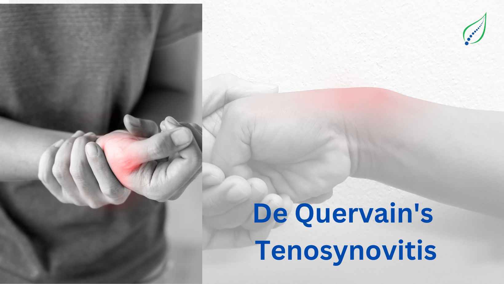 De Quervain’s Tenosynovitis